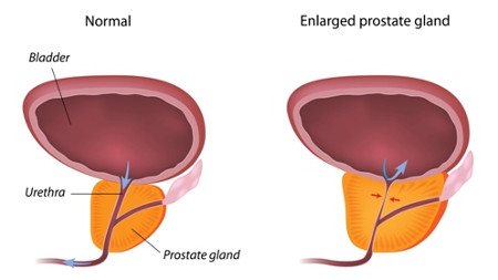 Enlarged Prostate Rendering