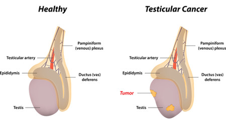 Testicular Cancer Rendering
